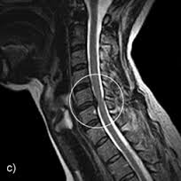 neck MRI disc herniation