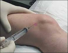 ozone therapy, knee injection. shoulder injection, hip injection