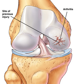 knee arthritis, knee DJD , osteoarthritis, arthritis