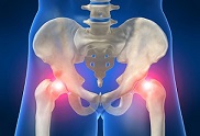 hip osteoarthritis video, hip pain