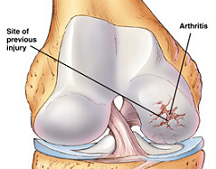 knee osteoarthritis video, knee osteoarthritis
