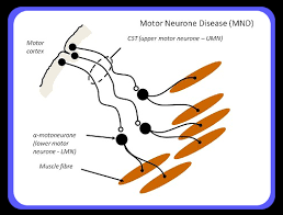 Motor neuron diseases & ALS