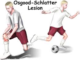 Osgood-Schlatter disease , knee pain