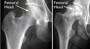 osteonecrosis of hip, osteonecrosis of femoral head