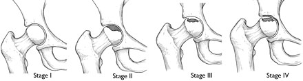 stages of osteonecrosis of hip, osteonecrosis of femoral head