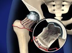 osteonecrosis of hip, osteonecrosis of femoral head