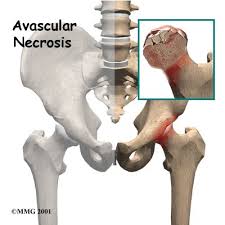 osteonecrosis of hip, osteonecrosis of femoral head,avascular necrosis of hip