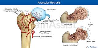 osteonecrosis of hip, osteonecrosis of femoral head,avascular necrosis of hip