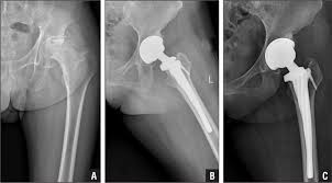 surgery of avascular necrosis, total hip arthroplasty