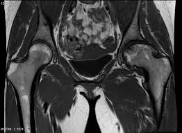 MRI OF OSTEONECROSIS OF HIP, Avascular necrosis of hip